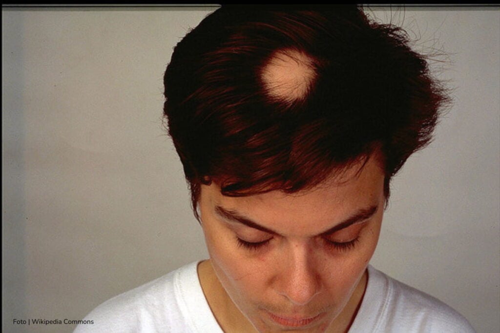 alopecia areata, Persona con alopecia, Más Colombia