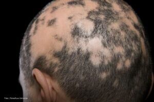 alopecia areata, Personas con enfermedad de alopecia areata, Más Colombia