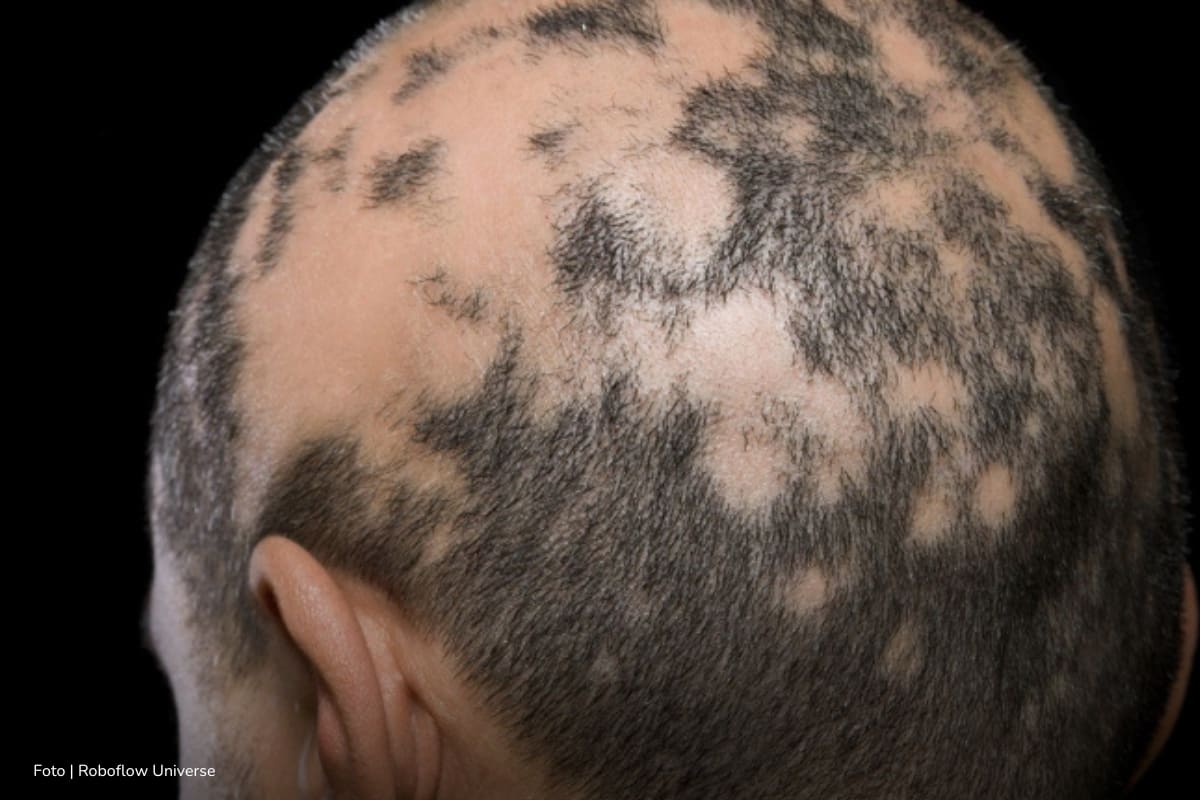 alopecia areata, Personas con enfermedad de alopecia areata, Más Colombia