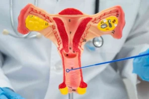 eliminación del cáncer VPH