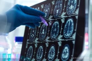 Alzheimer’s research, Alzheimer’s research, Más Colombia