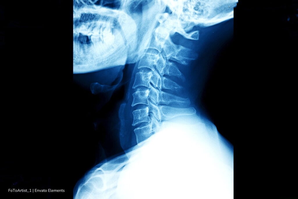 ¡Preocupante! Síndrome de cabeza caída alerta por una condición ligada a hábitos con el celular 2 síndrome de cabeza caída, uso excesivo del celular, síndrome de cabeza caída, Más Colombia